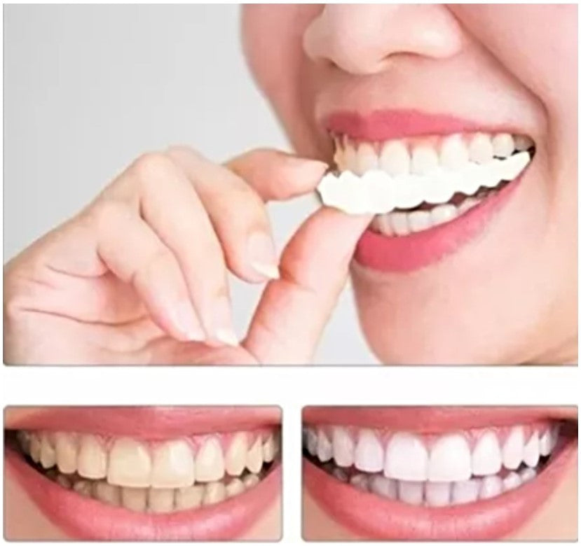 Tu Sonrisa Perfecta: Carillas Dentales 🚨 ¡OFERTA POR TIEMPO LIMITADO!