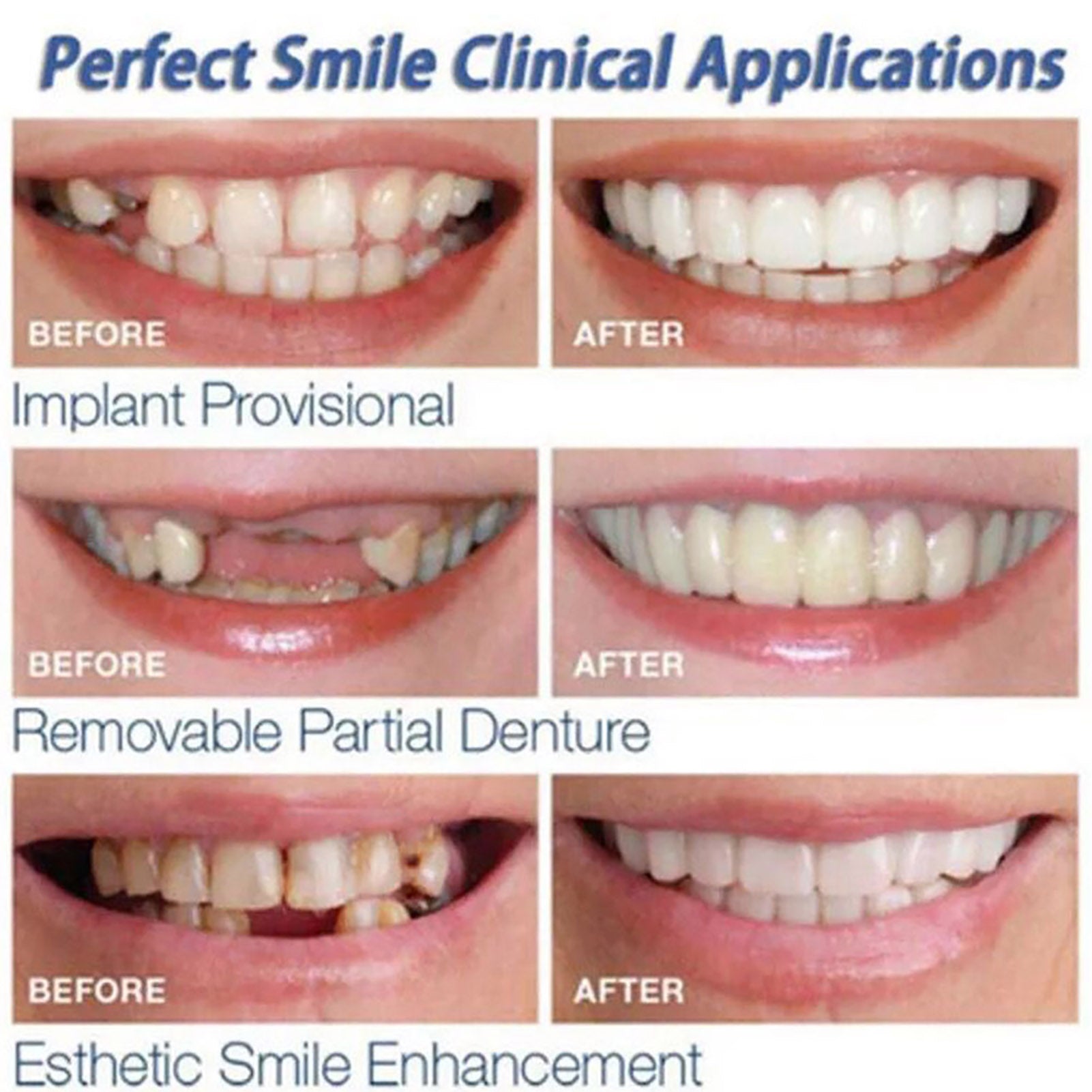 Tu Sonrisa Perfecta: Carillas Dentales 🚨 ¡OFERTA POR TIEMPO LIMITADO!